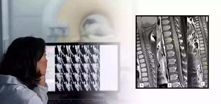 What you should about Dorsal Spine MRI